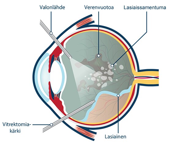 vitrektomia